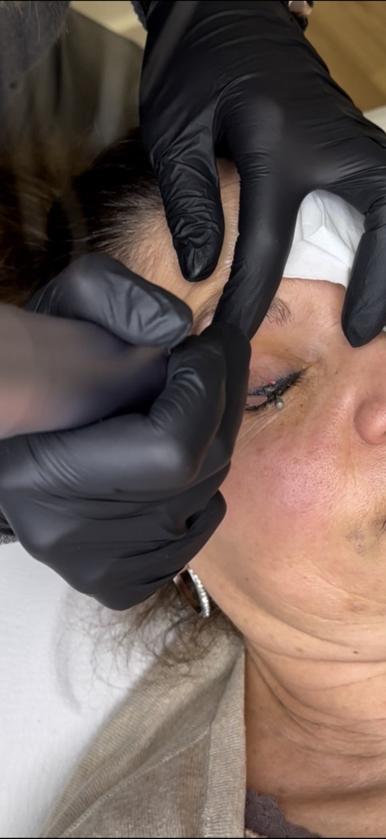 Eliminación con láser de micropigmentación en Alicante - Sandra Olcina Pérez
